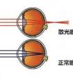 近視與遠視的區(qū)別？